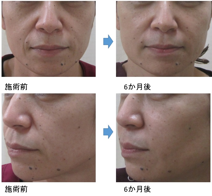 顔全体のグロースファクターによる頬のこけ改善