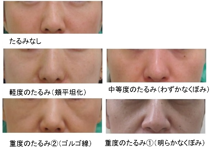 頬のたるみ ゴルゴ線 形成外科専門医が解説