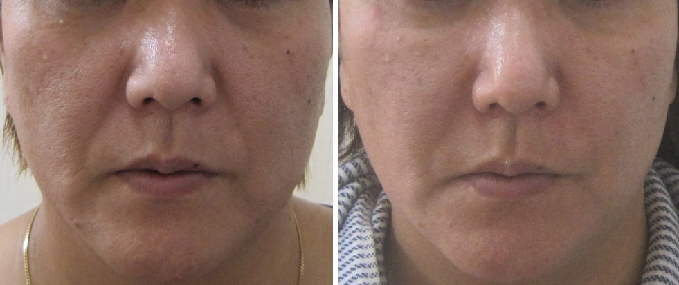 顔のたるみへの脂肪溶解注射 有効な場合と逆効果な場合の差