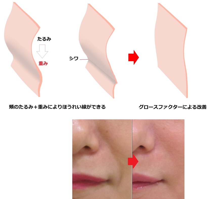 ほうれい線を最小限の手間と費用でリフトアップさせる5つの手順