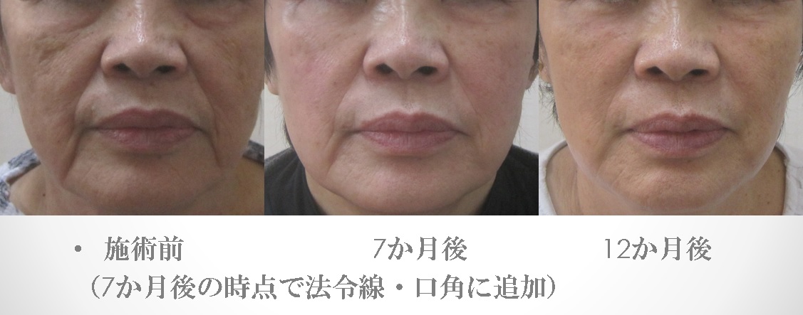 顔全体のグロースファクターによるシワたるみ治療1年の経過