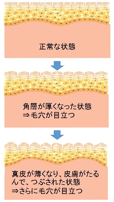 顔のたるみによる毛穴の開き 皮膚の2つの層への治療が効果的