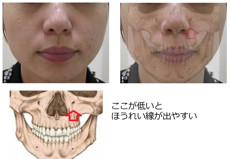 鼻横のくぼみ・へこみと骨格の関係