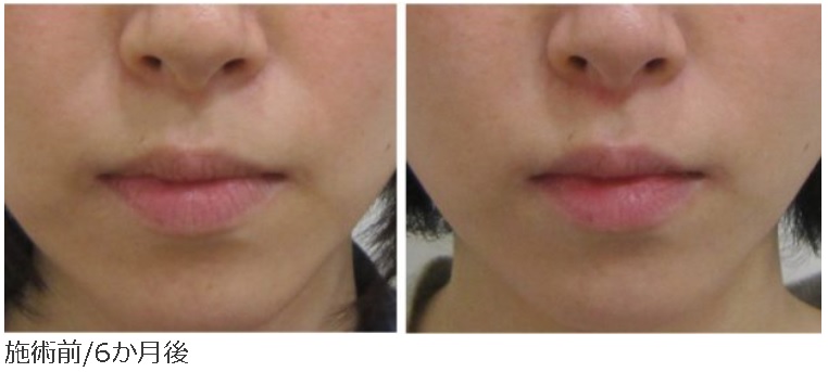 鼻横のほうれい線の改善例-30代