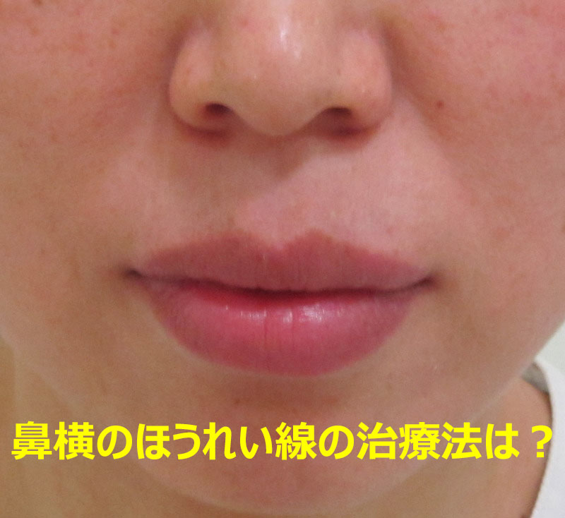 鼻横のほうれい線の治療法について