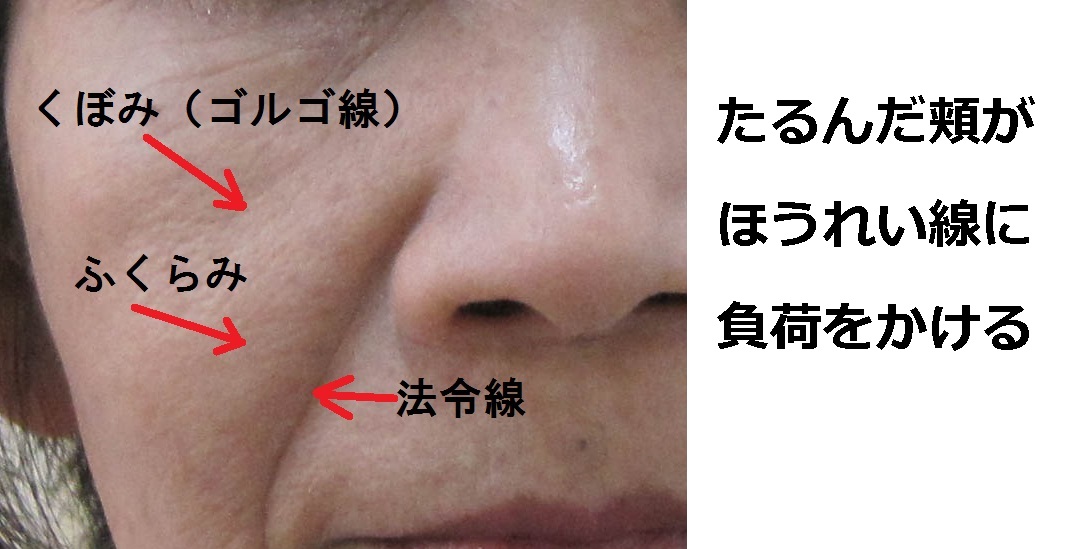 鼻の横のほうれい線の3つの原因と簡単な2つの治し方