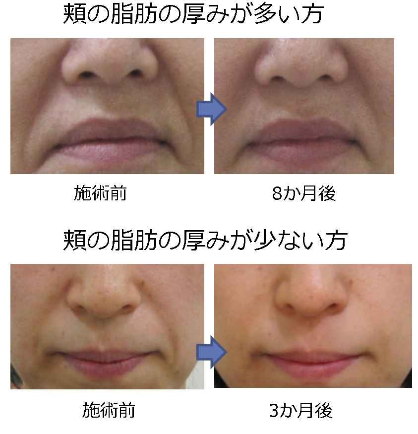 ほうれい線の原因について 形成外科専門医が解説