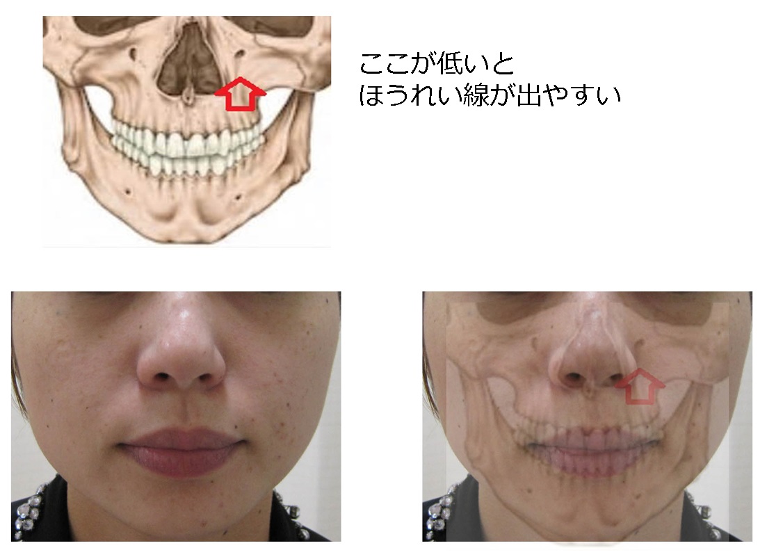 代の方向け ほうれい線を1回の治療で改善し長期維持する方法