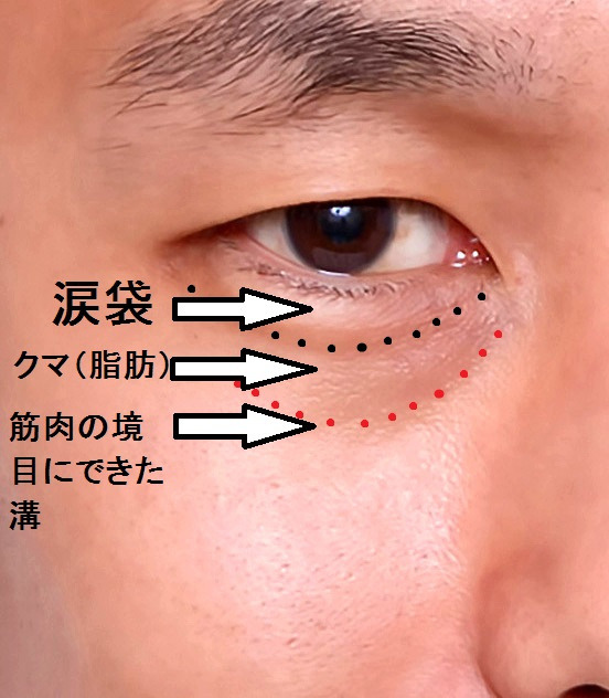 涙袋とは何でしょうか 目の下の専門クリニックが画像で解説