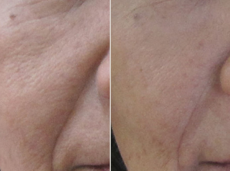 顔のたるみによる毛穴の開き 皮膚の2つの層への治療が効果的