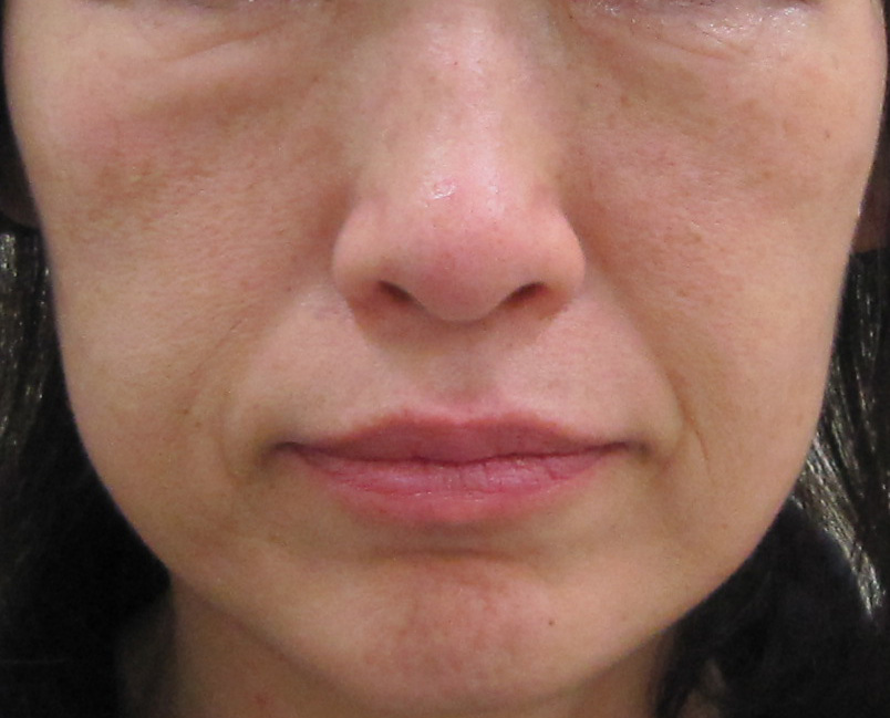 頬のたるみ ゴルゴ線 原因 失敗しない治療法の選び方を解説