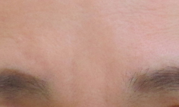 50代女性 眉間のシワ治療 グロースファクター 9か月後の経過